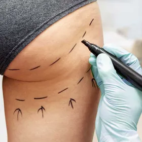Ninfoplastia